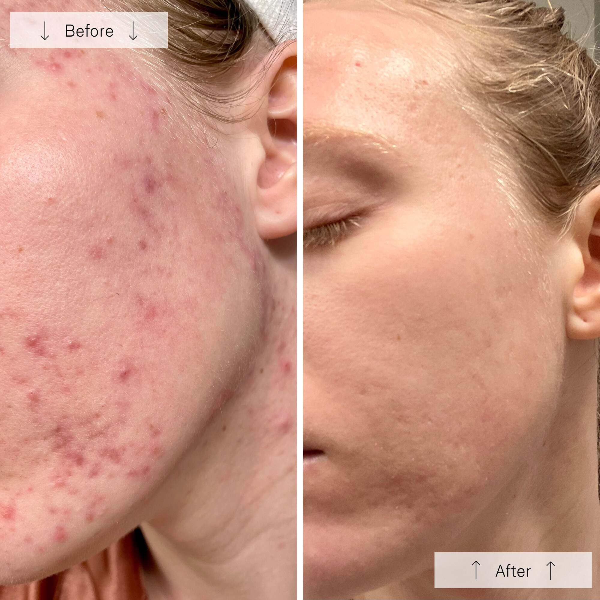 OmniLux Clear LED Mask - Image 7