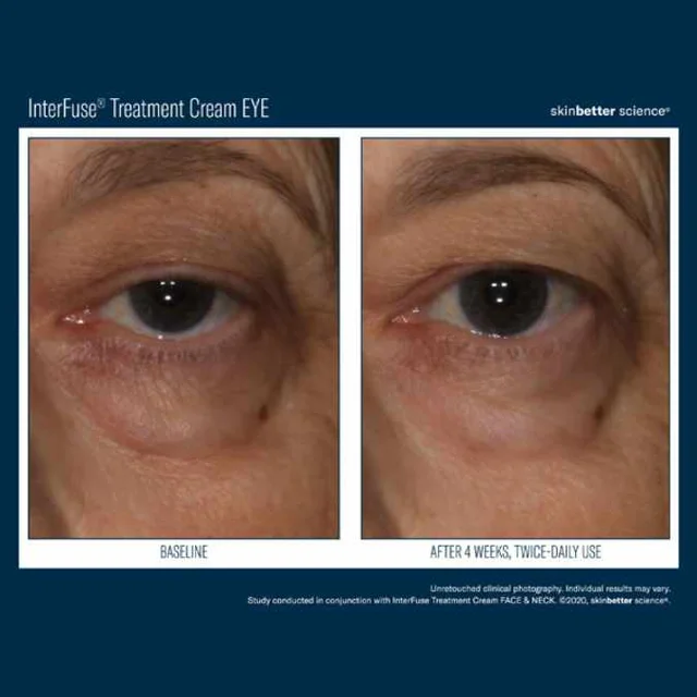Interfuse Treatment Cream EYE 15ml - Image 4